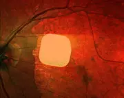 Medical Miracle: Electronic Implant Successfully Restores Sight to Blind Patients in UK Trial
