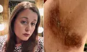 Mitchum Deodorant Faces Legal Action Over Severe Skin Burns and Chemical Injuries