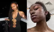Model's Agony: Acid Attack Survivor Reveals Her Skin Is Deteriorating Years After Brutal Assault