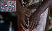 New Mpox Strain Detected in Los Angeles: Health Authorities Issue Urgent Warning