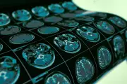 NHS Rejects Groundbreaking Brain Cancer Drug Vorasidenib in Major Blow to Patients