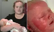 Perth Baby's Severe Sunburn on Rainy Day Sparks Urgent UV Warning for UK Parents