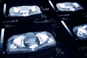 Prostate Cancer Breakthrough: UK Experts Debunk Common Myths That Could Save Lives