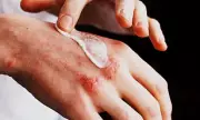 Revolutionary Skin Creams With Cancer-Fighting Properties Now Available on NHS Prescription