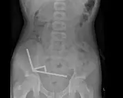 Temu Magnet Horror: Surgeons Remove Dangerous Buckyballs from Teen's Gut
