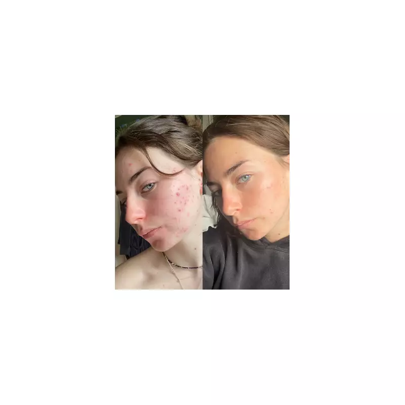 47 Skin's Award-Winning Serum Now £24, Offering Hope for Problem Skin