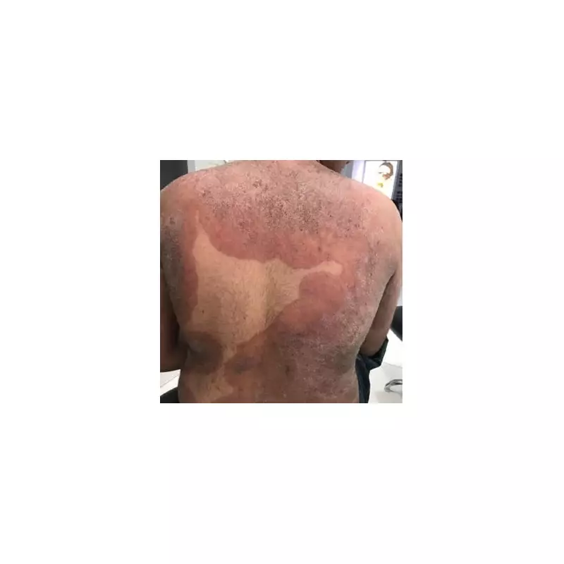 Drug-Resistant 'Super Fungus' Cases Surge 500% in UK