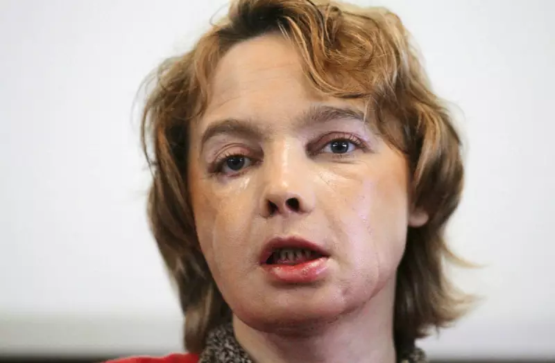 Face Transplants: 20 Years of Hope, Hardship and Ethical Dilemmas