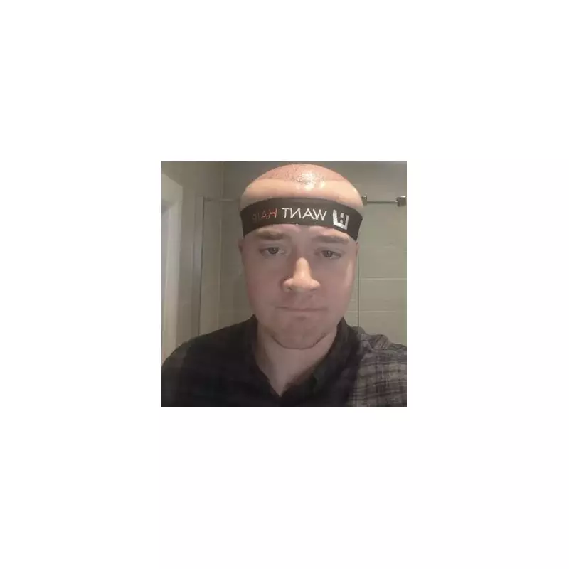 Man's Head Swells to Megamind Size After £3,500 Hair Transplant