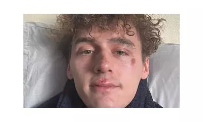 Big Brother Winner Cameron Cole Reveals Shocking Homophobic Attack Left Him With Black Eye