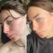 47 Skin's Award-Winning Serum Now £24, Offering Hope for Problem Skin