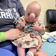 Baby Liam's Miracle: Born with Brain Bubble, Defying All Odds