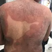 Drug-Resistant 'Super Fungus' Cases Surge 500% in UK