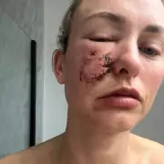 Laser Treatment Heals Dog Bite Scar, Restores Woman's Confidence