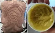 Woman's Skin Turns Snake-Like After 10 Years of Online Cream Use