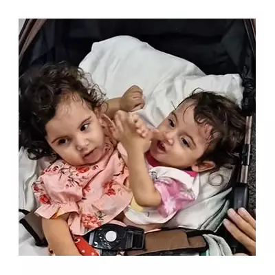 Conjoined Twin Aruna Dies 7 Months After 19-Hour Separation Surgery
