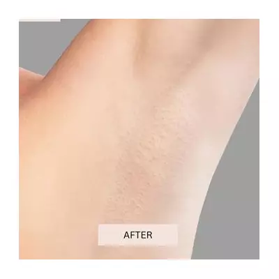 Keskine's 'Holy Grail' IPL Hair Removal Device Hits Record Low Price of £149.25