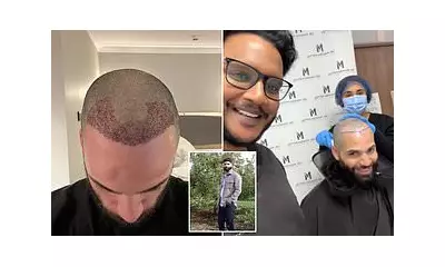 London Emerges as New Hair Transplant Hub for Americans, Challenging Turkey's Dominance