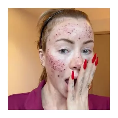 Olivia Attwood's Bloodied Face After CO2 Laser Shocks Fans & Husband Bradley Dack