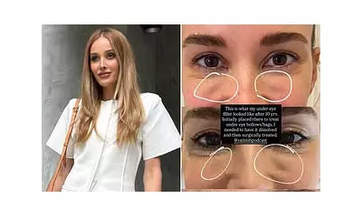 Rebecca Judd's 10-Year Eye Filler Journey: Dissolving, Surgery & Regrets