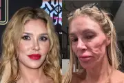 Brandi Glanville's $130k Health Battle: Diagnosis After Years of Facial Disfigurement