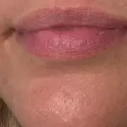 Dermatologist's Roller Gel Transforms Acne Treatment, Users 'Don't Know How I Lived Without It'