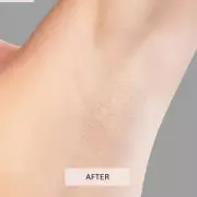 Keskine's 'Holy Grail' IPL Hair Removal Device Hits Record Low Price of £149.25