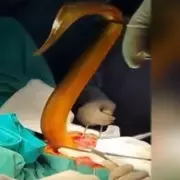 Man, 31, Undergoes Emergency Surgery After Live Eel Eats Through Bowel
