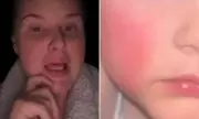 Mum's Fury as Toddler Suffers Sunburn Four Times in a Month at Daycare