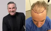Nick Ede's Hair Transplant Journey: From Suicidal Thoughts to Joy at 50