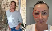 Nicky Buckley, 60, Shares Eye Surgery Recovery Photos: 'No Sympathy Please'