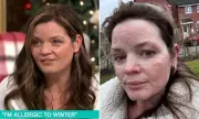 This Morning Guest Reveals Rare Allergy to Cold: 'My Skin Feels Like It's On Fire'
