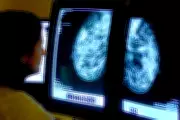 AI Mammography Trial Shows 27% Drop in Aggressive Breast Cancers