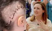 Antiques Roadshow's Theo Burrell, 38, Shares 'Gory' Brain Surgery Scar After Terminal Tumour Diagnosis