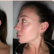 Boots £11 Spot Cream Sparks 'Wow' Skin Transformations for Women