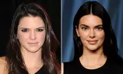 Kendall Jenner Denies Facial Surgery, Admits Only to Baby Botox