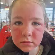 Mum's Horror as Daughter's Face Peels After Using Primark Cleanser