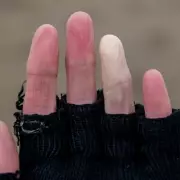 NHS Alert: Why Your Fingers and Toes Change Colour in the Cold
