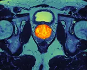 NHS England Expands Prostate Cancer Drug, Set to Save Thousands of Lives