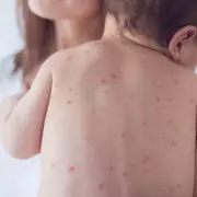 NHS Launches Chickenpox Vaccine in 'Historic Milestone' for Child Health