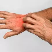 Scabies Cases Surge 20% Across UK as Victorian-Era Skin Infection Returns