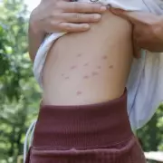 Scabies Cases Surge 20% in UK as Experts Warn of Misinformation Crisis