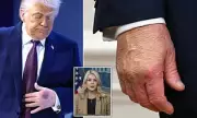 Trump's Bruised Hand Mystery: White House Blames Davos Table Incident