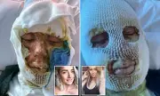 Two Women Suffer Horrific Burns After Pub Heater Explosion in Suffolk