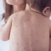 UK Loses Measles-Free Status as Cases Surge Nationwide - Check Your Local Area