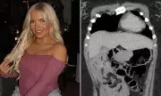 Woman, 25, Had Stomach Cancer Dismissed as 'Women's Problems' by Doctors