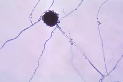 Aspergillus Mould Outbreak at Sydney Hospital Claims Two Lives