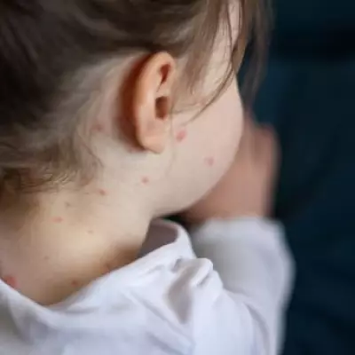 Major Measles Outbreak Hits London Schools: Parents Urged to Check Vaccinations