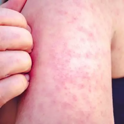 Toddler's Life-Threatening Battle with Measles After Nursery Outbreak