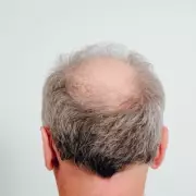 Ancient Chinese Herb He Shou Wu Offers Multi-Target Hope for Hair Loss Treatment